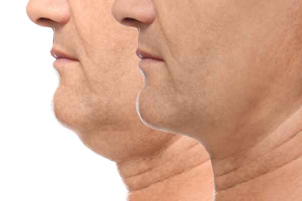 HIFU - Breakthrough in Anti - ageing 2 hifu results Virginia Water