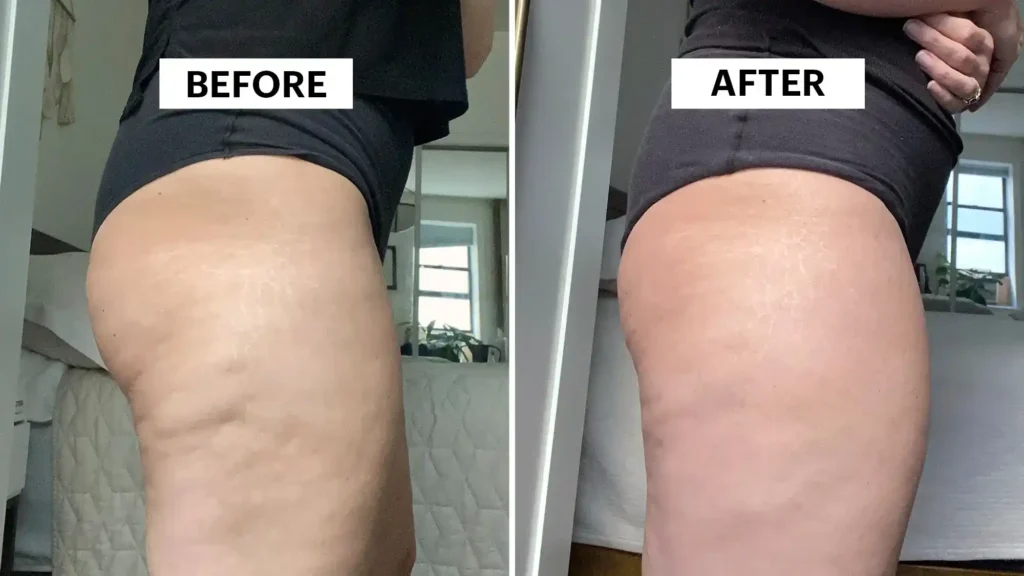 Sculpting Your Bum: Can Toning Exercises Really Reduce Cellulite? 1 Do Toning Exercise Virginia Water Really Tackle Cellulite?