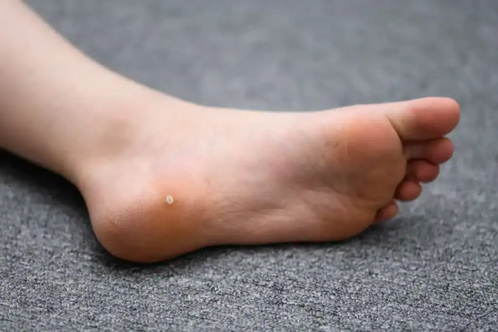 Cryotherapy For Warts And Also Verrucas 2 Image of verruca on the bottom of the foot that able to be treated with Cryotherapy Virginia Water