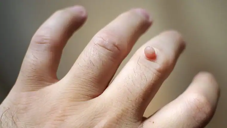Cryotherapy For Warts And Also Verrucas 1 Image of blemish that Cryotherapy Virginia Water can remove with Lipo 360.