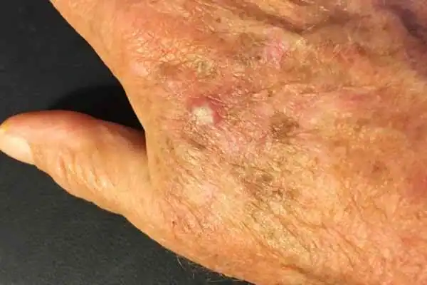 Image of Actinic keratoses Virginia Water on a person hand
